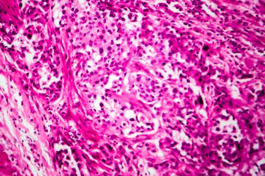 Mesane kanseri, hafif mikrograf, mikroskop altında fotoğraf.