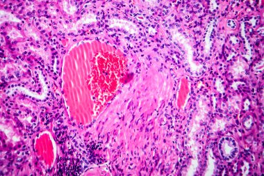Hipertansif böbrek hastalığının Histopatolojisi, ışık mikrografı, mikroskop altında fotoğraf