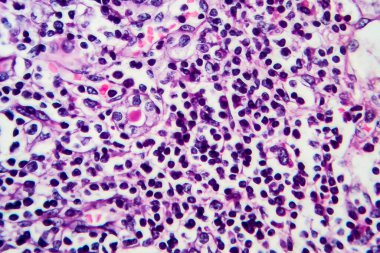 Kronik nefrit, hafif mikrograf, mikroskop altında fotoğraf. Yüksek büyütme