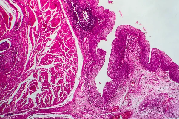 Καρκίνος Της Ουροδόχου Κύστης Μικρογραφία Φωτός Φωτογραφία Στο Μικροσκόπιο — Φωτογραφία Αρχείου