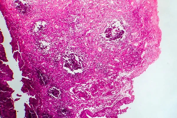 Blasenkrebs Lichtmikroskopie Foto Unter Dem Mikroskop — Stockfoto