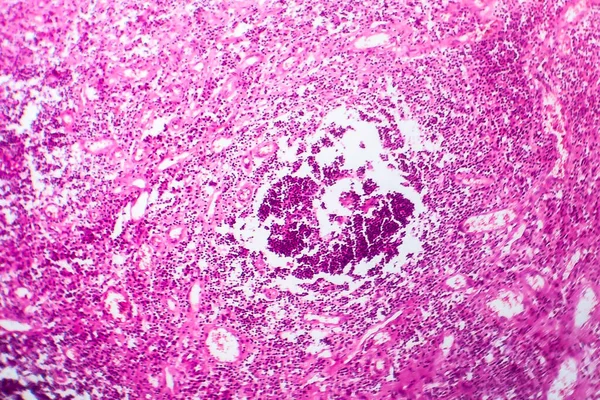 Καρκίνος Της Ουροδόχου Κύστης Μικρογραφία Φωτός Φωτογραφία Στο Μικροσκόπιο — Φωτογραφία Αρχείου