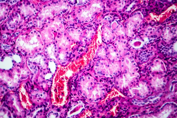 高血圧腎疾患の組織学 光マイクログラフ 顕微鏡下での写真 — ストック写真