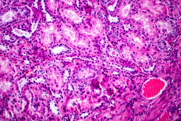 Histopatología Enfermedad Renal Hipertensiva Micrografía Ligera Fotografía Microscopio —  Fotos de Stock