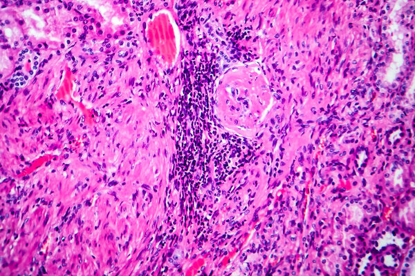 Histopathology of hypertensive renal disease, light micrograph, photo under microscope