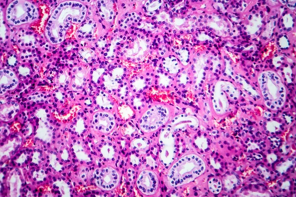 Histopatología Enfermedad Renal Hipertensiva Micrografía Ligera Fotografía Microscopio —  Fotos de Stock