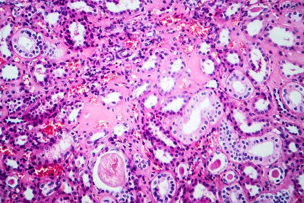 Histopatologie Hypertenzního Onemocnění Ledvin Světelný Mikrograf Fotografie Pod Mikroskopem — Stock fotografie