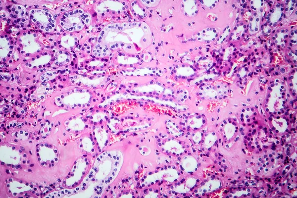 Histopatologia Doença Renal Hipertensiva Microscópio Leve Foto Sob Microscópio — Fotografia de Stock