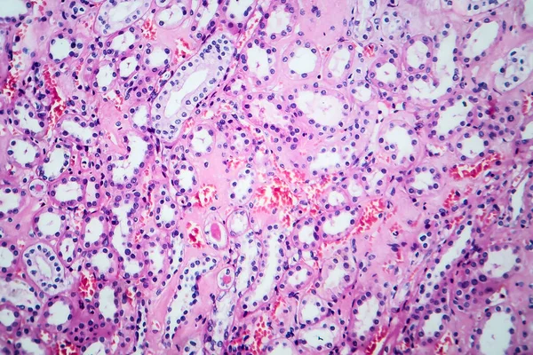 Histopatologia Doença Renal Hipertensiva Microscópio Leve Foto Sob Microscópio — Fotografia de Stock