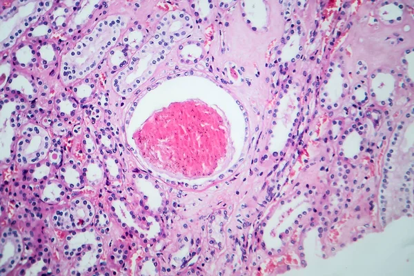 Histopatologie Hypertenzního Onemocnění Ledvin Světelný Mikrograf Fotografie Pod Mikroskopem — Stock fotografie