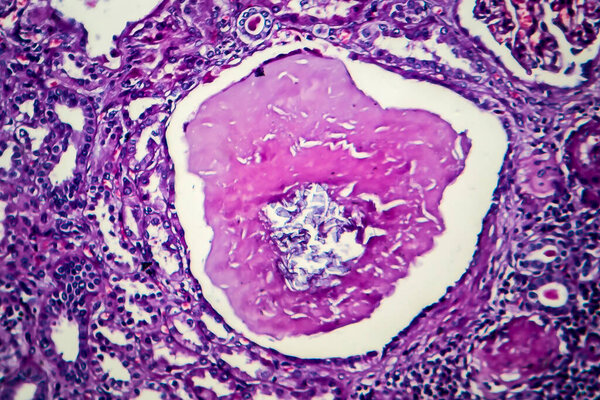 Chronic nephritis, light micrograph, photo under microscope