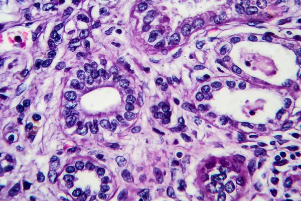 Chronic nephritis, light micrograph, photo under microscope. High magnification