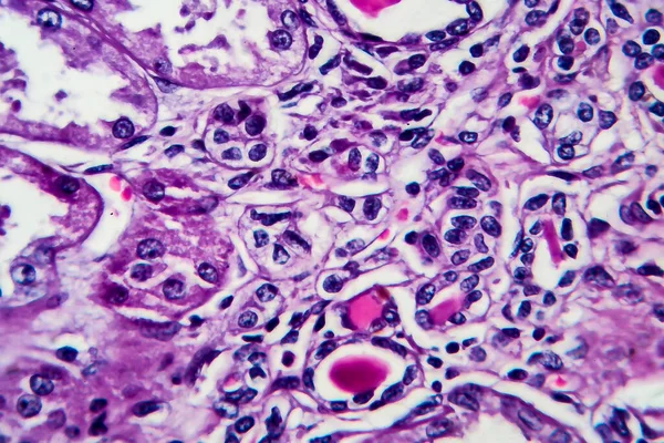 Chronische Nephritis Lichtmikroskopie Foto Unter Dem Mikroskop Hohe Vergrößerung — Stockfoto