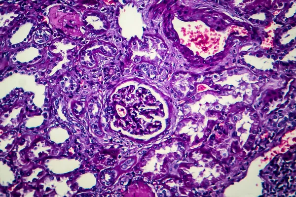 Хронический Нефрит Светлый Микрограф Фото Микроскопом — стоковое фото