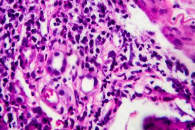 İnce bağırsak iltihabı, ışık mikrografı, mikroskop altında fotoğraf.