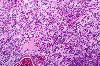 İnce bağırsak iltihabı, ışık mikrografı, mikroskop altında fotoğraf.