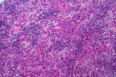 İnce bağırsak iltihabı, ışık mikrografı, mikroskop altında fotoğraf.