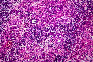 İnce bağırsak iltihabı, ışık mikrografı, mikroskop altında fotoğraf.