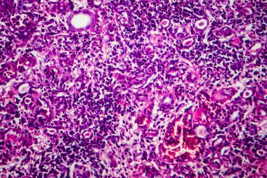 İnce bağırsak iltihabı, ışık mikrografı, mikroskop altında fotoğraf.