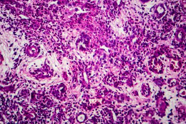 İnce bağırsak iltihabı, ışık mikrografı, mikroskop altında fotoğraf.