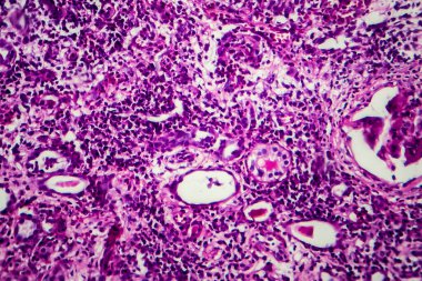 İnce bağırsak iltihabı, ışık mikrografı, mikroskop altında fotoğraf.