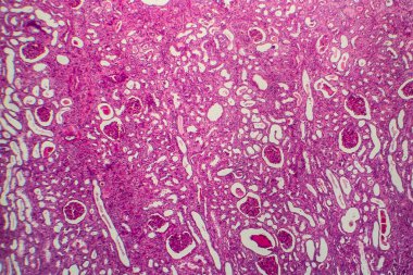 Kronik piyelonefrit, ışık mikrografı, mikroskop altında fotoğraf.