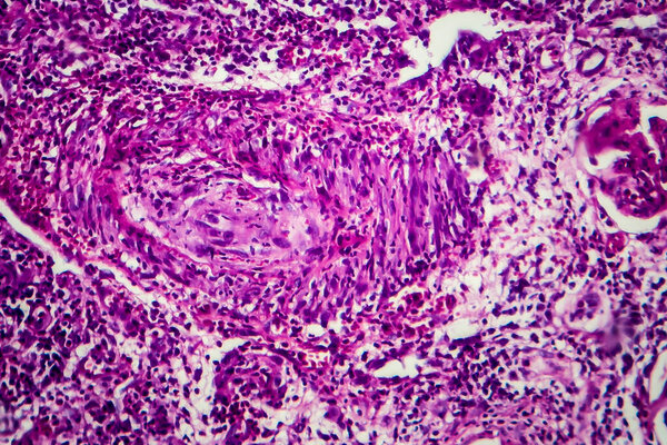 Histopathology of interstitial nephritis, light micrograph, photo under microscope