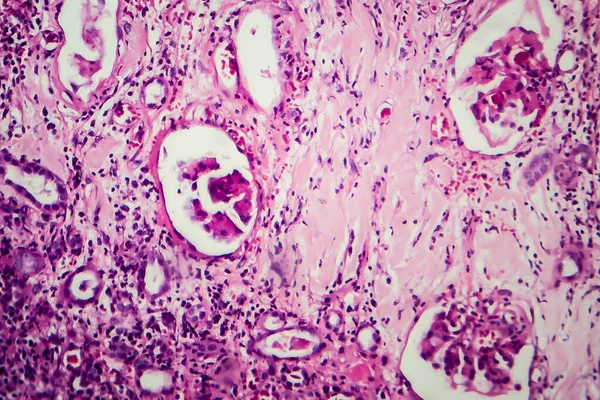 Histopathologie Der Interstitiellen Nephritis Lichtmikroskopie Foto Unter Dem Mikroskop — Stockfoto
