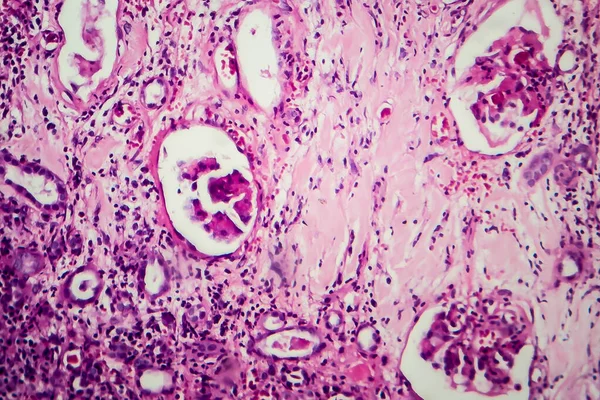 Istopatologia Della Nefrite Interstiziale Microscopio Luce Foto Microscopio — Foto Stock