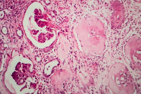 Histopatologia Nefrite Intersticial Micrografia Leve Foto Sob Microscópio — Fotografia de Stock