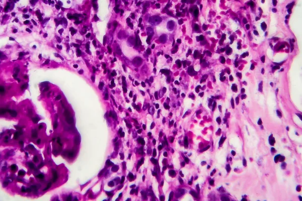 Histopatología Nefrotis Intersticial Micrografía Ligera Fotografía Microscopio — Foto de Stock