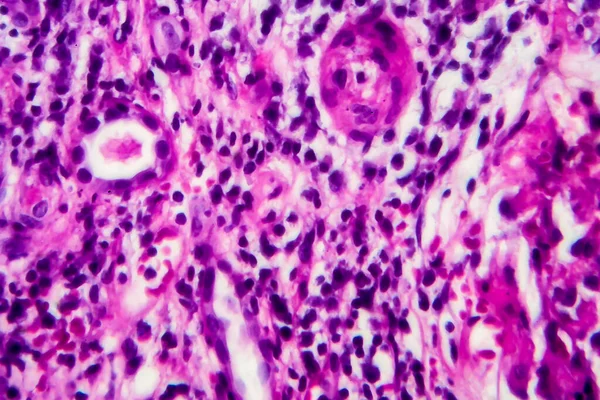 Histopatologia Nefrite Intersticial Micrografia Leve Foto Sob Microscópio — Fotografia de Stock