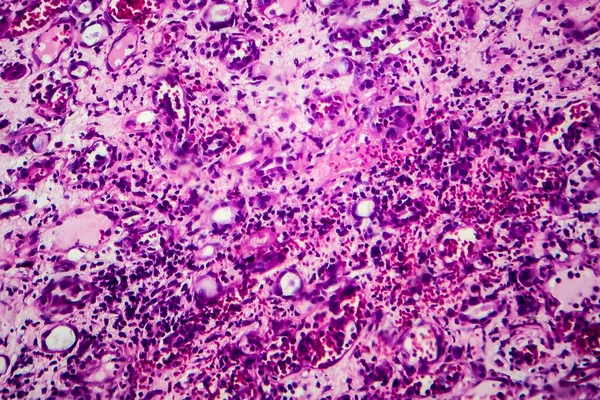 Histopatología Nefrotis Intersticial Micrografía Ligera Fotografía Microscopio — Foto de Stock