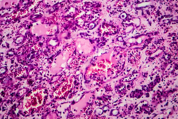 Histopatologie Intersticiální Nefritidy Světelný Mikrograf Fotografie Pod Mikroskopem — Stock fotografie