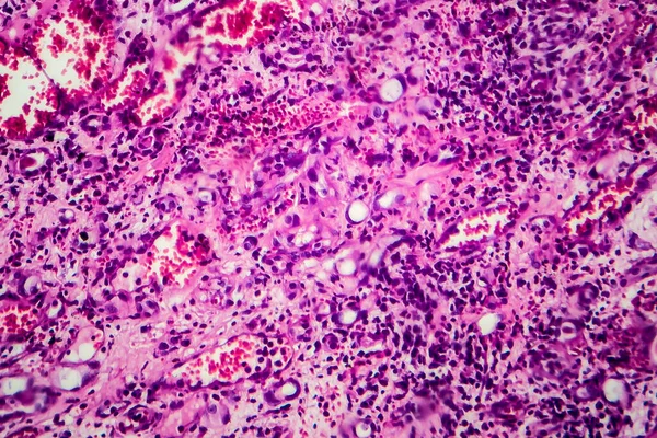 Interstitialis Nephritis Szövettani Vizsgálata Fénymikrográf Fotó Mikroszkóp Alatt — Stock Fotó