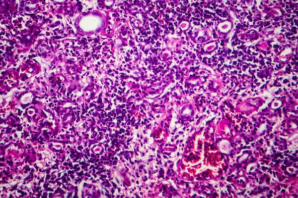 Гистопатология Интерстициального Нефрита Световой Микрограф Фото Микроскопом — стоковое фото