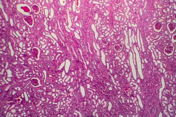 慢性腎炎 軽いマイクログラフ 顕微鏡下の写真 — ストック写真
