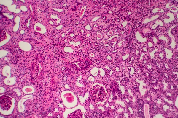Chronická Pyelonefritida Světelný Mikrograf Fotografie Pod Mikroskopem — Stock fotografie
