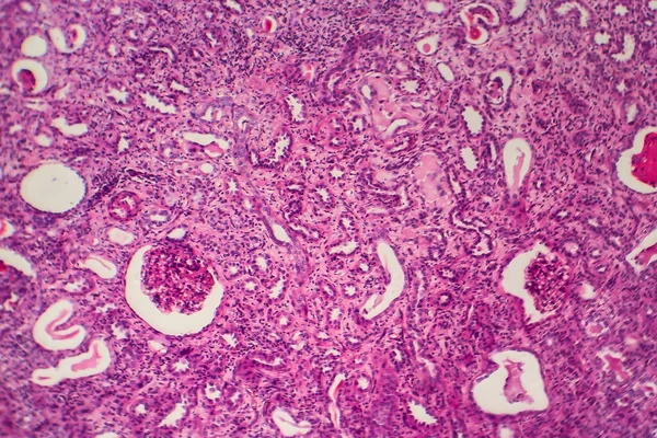 Pyelonefritis Kronis Mikrograf Cahaya Foto Bawah Mikroskop — Stok Foto