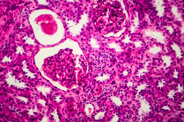 慢性肾小球肾炎 显微镜下照片 — 图库照片
