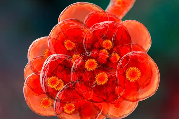 Στεφανιαία Πνευμονία Κυψελίδες Γεμάτες Covid Novel Chinese Wuhan Coronavirus 2019 — Φωτογραφία Αρχείου