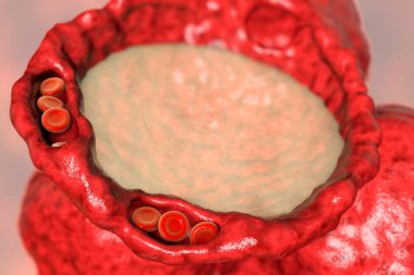 Pulmoner ödem, alveolus kesitinin yakın görüntüsü alveolusta sıvı, genişlemiş kılcal damarlar ve kalınlaşmış alveolar duvar, 3D çizim