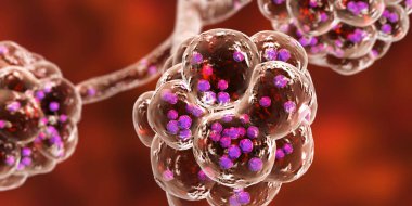 Stafilokok zatürree, tıbbi konsept. Alveollerde Staphylococcus aureus bakterisini gösteren 3D çizim