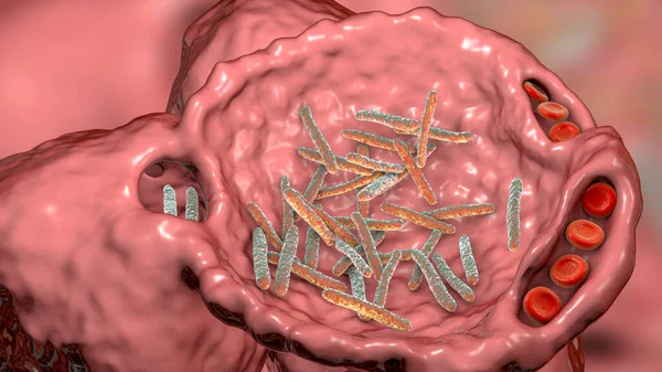 Pneumonie Bactérienne Concept Médical Illustration Montrant Des Bactéries Forme Tige — Photo