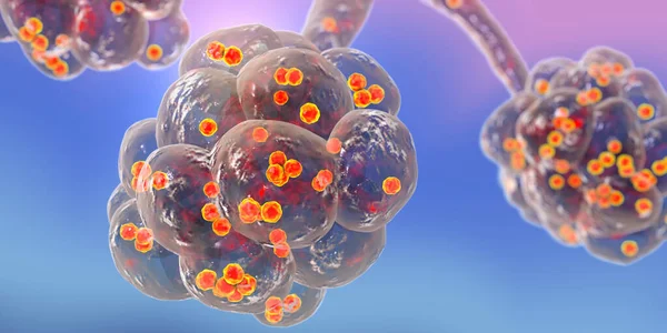 Stafylokockpneumoni Medicinskt Koncept Illustration Som Visar Bakterier Staphylococcus Aureus Inuti — Stockfoto