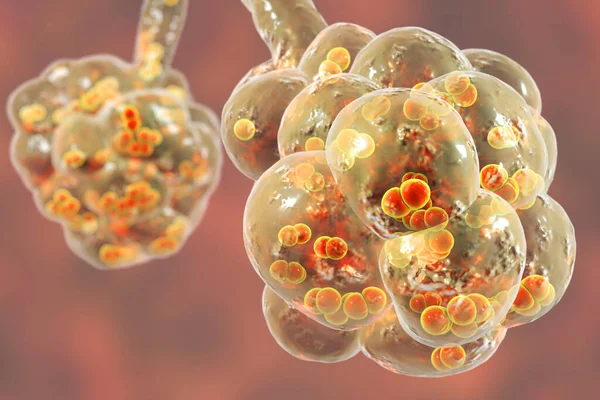 Pneumokokkenlongontsteking Medisch Concept Illustratie Tonen Bacteriën Streptococcus Pneumoniae Alveoli — Stockfoto