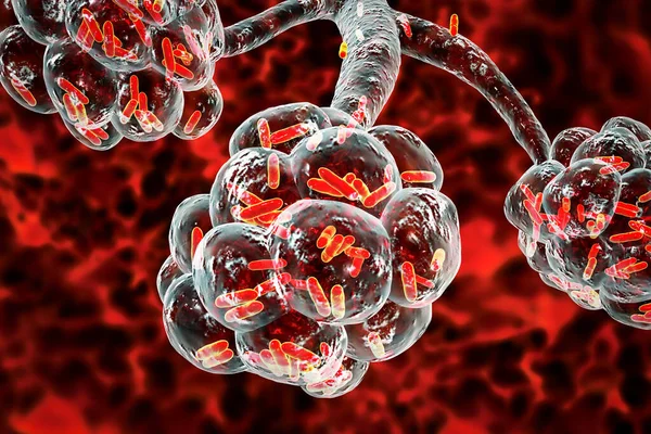 細菌性肺炎 医療概念 図3は 肺胞内のロッド状細菌を示しています — ストック写真