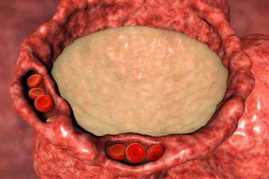 Pulmoner ödem, alveolus kesitinin yakın görüntüsü alveolusta sıvı, genişlemiş kılcal damarlar ve kalınlaşmış alveolar duvar, 3D çizim