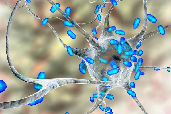 Bakterien Infizieren Neuronen Gehirnzellen Illustration Konzeptionelle Darstellung Bakterieller Enzephalitis Meningitis — Stockfoto
