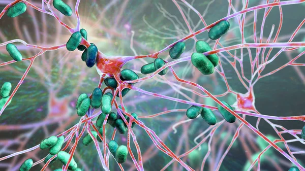 Bacteria infecting neurons, brain cells, 3D illustration. Conceptual illustration of bacterial encephalitis, meningitis, bacterial infection of brain tissue